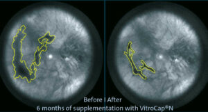 How I cured my eye floaters – reduction of vitreous opacity density after supplementation with L-lysine, vitamin C, Vitis vinifera extract (procyanidines), zinc, and Citrus aurantium flavonoids