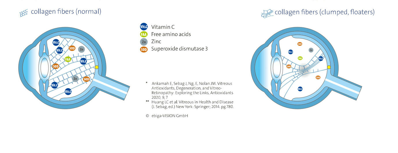 Has anyone ever cured floaters? - Schematic image depicting clumped and normal fibers in the vitreous body and the role of micronutrients.