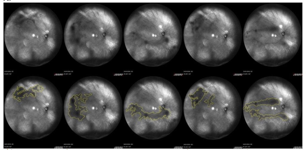 Capture des zones d'opacité vitréenne des corps flottants avec Heidelberg Spectralis : étude FLIES